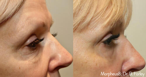 Mini-FaceLift-Eyes-2