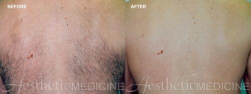 Dr.-Darm-Hair-Removal-Before-and-After-1