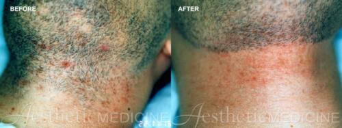 Dr.-Darm-Hair-Removal-Before-and-After-2