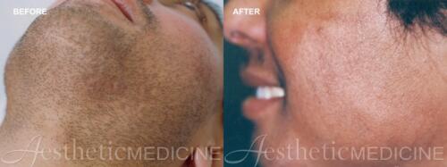 Dr.-Darm-Hair-Removal-Before-and-After-3