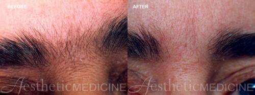 Dr.-Darm-Hair-Removal-Before-and-After-6