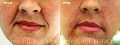 Dr.-Darm-Juvederm-Before-and-After-1