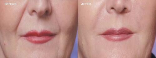 Dr.-Darm-Juvederm-Before-and-After-2
