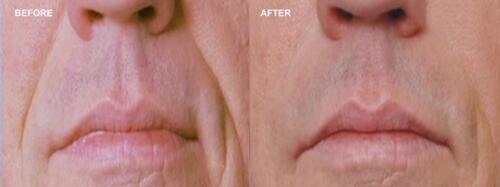 Dr.-Darm-Juvederm-Before-and-After-3