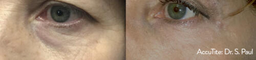 Mini-FaceLift-Eyes-4