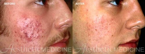 acne-and-acne-scarring-10