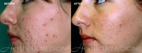 acne-and-acne-scarring-11