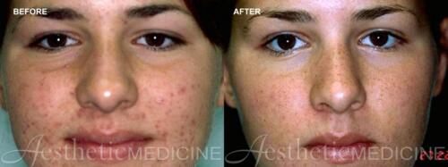acne-and-acne-scarring-14