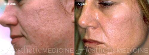 acne-and-acne-scarring-3