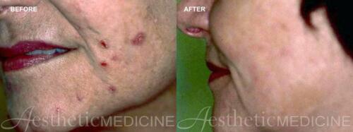 acne-and-acne-scarring-6