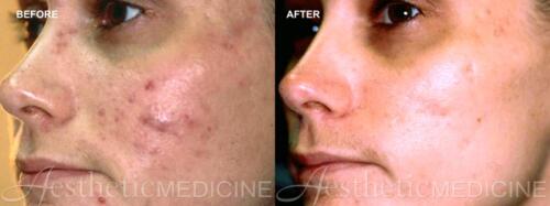 acne-and-acne-scarring-7