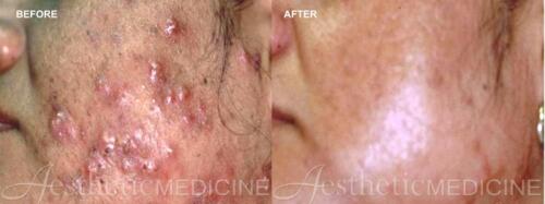 acne-and-acne-scarring-8