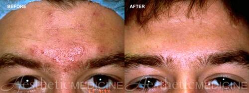 acne-and-acne-scarring-9