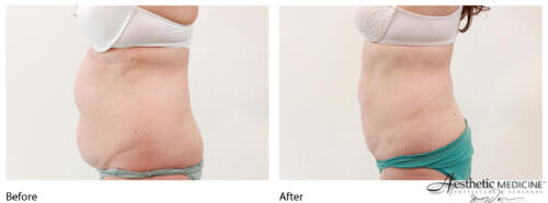 lipolift-abs-small-35