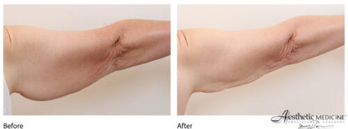 lipolift-arms-31