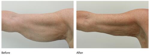 lipolift-arms-32